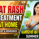 heat rash treatment at home